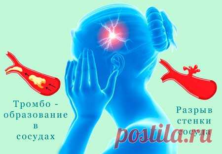 По секрету всему свету| Про инсульт: заблуждения и факты, о чем полезно знать
У инсульта есть три основных типа. Наиболее опасный, на который приходится около 90 процентов случаев, это – ишемический инсульт. Он происходит, когда поток крови через артерию, которая снабжает кислородом мозг, блокируется. Такое острое нарушение в кровообращения можно назвать инфарктом головного мозга. К сожалению, именно он является наиболее частой причиной летальных исходов.
