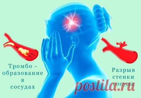 По секрету всему свету| Про инсульт: заблуждения и факты, о чем полезно знать
У инсульта есть три основных типа. Наиболее опасный, на который приходится около 90 процентов случаев, это – ишемический инсульт. Он происходит, когда поток крови через артерию, которая снабжает кислородом мозг, блокируется. Такое острое нарушение в кровообращения можно назвать инфарктом головного мозга. К сожалению, именно он является наиболее частой причиной летальных исходов.