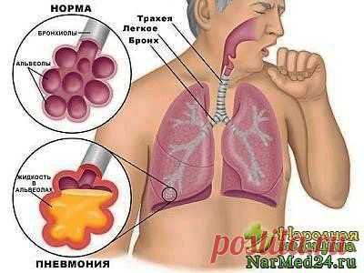 Пневмония: симптомы, признаки и лечение народными средствами..