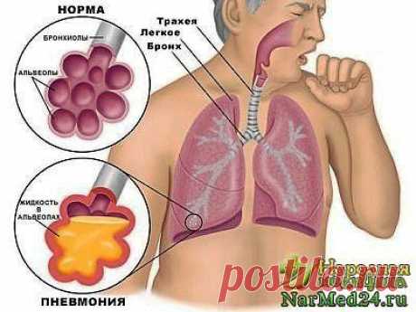 Пневмония: симптомы, признаки и лечение народными средствами..