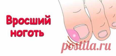 Народные методы лечения вросшего ногтя