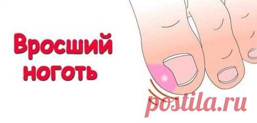 Народные методы лечения вросшего ногтя