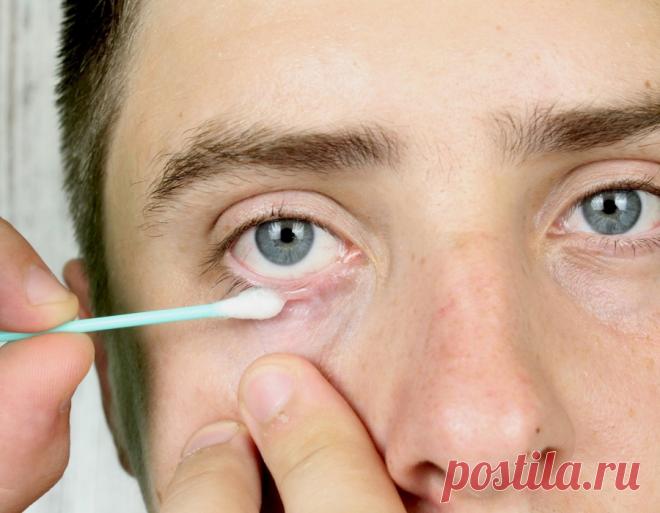 Ячмень_что_делать_в_домашних_условиях Народная медицина — рецепты, советы, способы, cекреты и народные средства.