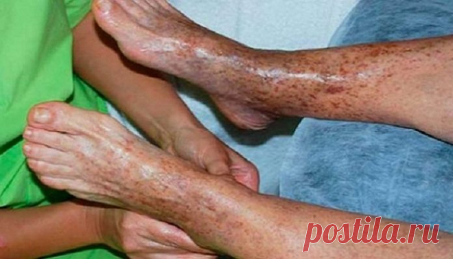 Эффективные советы о том, как решить проблему плохой циркуляции крови
