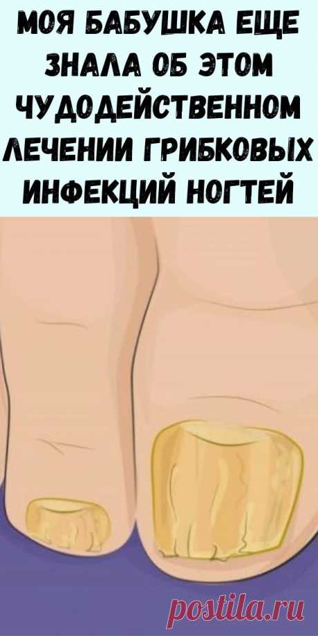 Моя бабушка еще знала об этом чудодейственном лечении грибковых инфекций ногтей. Сегодня рецепт почти забыт. - Интересный блог