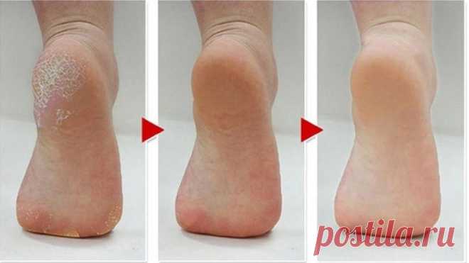 Средство, которое избавит от трещин на пятках