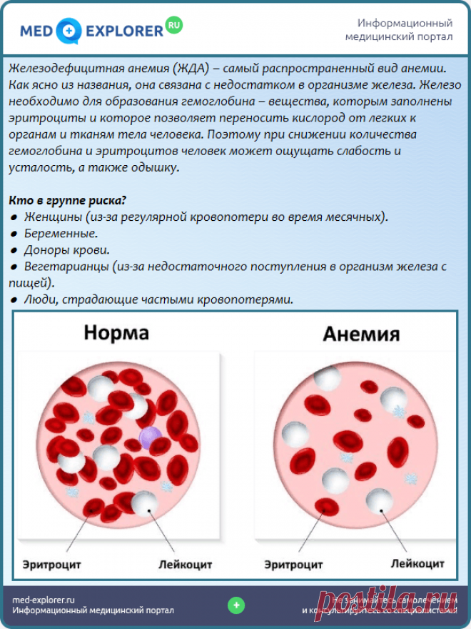Железодефицитная анемия