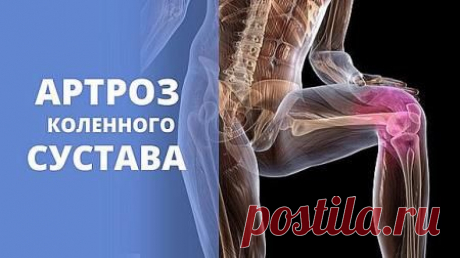 Лечение артроза коленного сустава от Бубновского