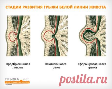 Грыжа белой линии живота: симптомы, фото, лечение