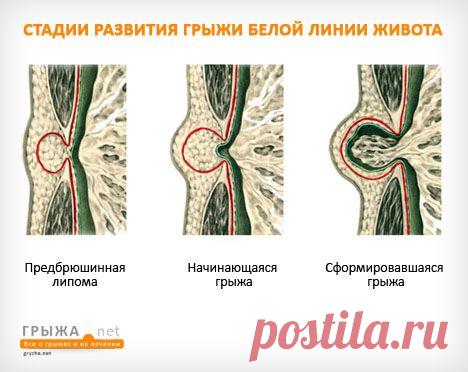 Грыжа белой линии живота: симптомы, фото, лечение