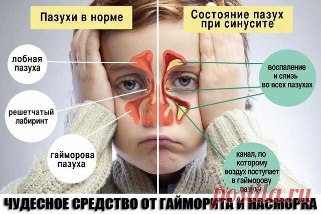 ЧУДЕСНОЕ СРЕДСТВО ОТ ГАЙМОРИТА И НАСМОРКА
С похолоданием приходят простудные заболевания, и особенно неприятный симптом - насморк или, не дай Бог, гайморит... Часто врачи сразу направляют на прокол, что,собственно,не столько лечит,сколько калечит...
Есть проверенный рецепт от гайморита, помогает на 100%.
Берешь березовые почки (в аптеке они продаются) и засыпаешь в чекушку водки (только водка, спирт не идет), примерно 1/5 части почек и остальное водка. Я так на глаз засыпа...