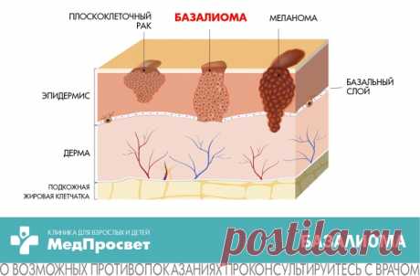 Базалиома или базальный рак кожи: симптомы, диагностика, лечение

Базалиома - рак кожи, развивающийся из атипичных базальных клеток эпидермиса и фолликулярного эпителия. В отличии от меланомы медленно прогрессирует и не дает метастазов. Первоначально опухоль развивается в дерме, но при отсутствии лечения может переходить в сухожилия, мышцы, хрящи и даже кости.
Показать полностью...