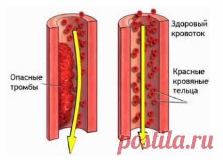 Профилактика образования тромбов.