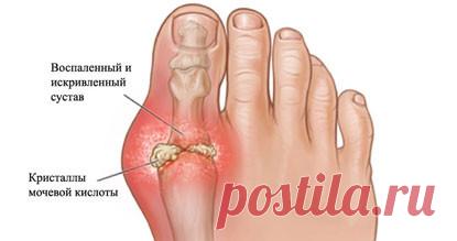 Подагра: болезнь, связанная с образом жизни — Народная Воля