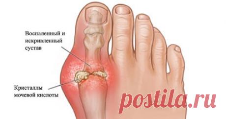 Подагра: болезнь, связанная с образом жизни — Народная Воля