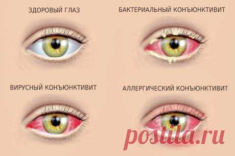 Коньюктивит: эффективное лечение натуральными средствами