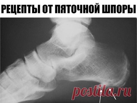 Пяточная шпора: 17 эффективных рецептов народной медицины

Пяточные шпоры - костные разрастания в виде шипа или клюва на подошве у пяточной кости или у места прикрепления ахиллова сухожилия. Лечение пяточных шпор процесс длительный. Избыточный вес, заболевания позвоночника и крупных суставов нижних конечностей, плоскостопие - все это может спровоцировать появление пяточной шпоры.

Лечение пяточной шпоры, наростов народными средствами:

Картофель от шпор на ногах.

Сварите ...