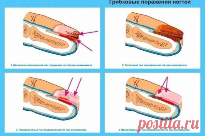 КАК ВЫЛЕЧИТЬ ГРИБОК НА НОГТЯХ