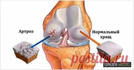 Результаты вы заметите очень скоро! Хрящ действует как подушечка, защищая ваши кости...