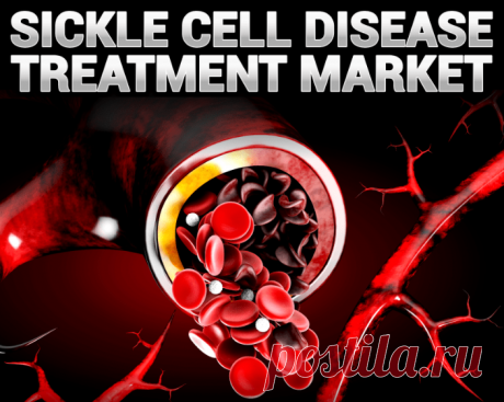 The sickle cell disease treatment market was estimated at USD 1.73 billion in 2021 and is expected to increase at a CAGR of 21.4% from USD 2.25 billion in 2022 to USD 8.75 billion by 2029.