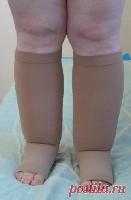 ЛИМФОЛОГИЯ.
Лимфология - раздел медицины, освещающий проблемы связанные с патологическими изменениями в лимфатической системе конечностей.
Пациент с отеками в области конечностей может обратиться за помощью к ряду специалистов, так как   появление отеков конечностей не является особенным проявлением какого-либо заболевания.