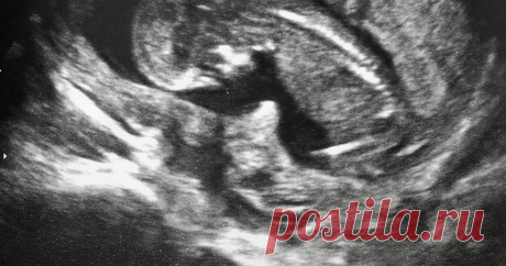 Удивительные факты о беременности и жизни малыша до рождения Находясь в животе у мамы, малыш ведет довольно активную жизнь. С определенного срока во время УЗИ можно наблюдать, как он морщит носик, сосет пальчик, икает и даже писает. О самых...