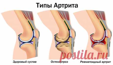 5 натуральных средств для лечения артрита и боли в суставах - Журнал для женщин Важная информация Артрит является наиболее распространенной причиной инвалидности во многих странах. По данным Центров по контролю и профилактике заболеваний, это заболевание затрагивает примерно 23% взрослых и 50% лиц в возрасте 65 лет и старше. Природные средства для лечения артрита: Куркума Куркума – ярко-желтая специя, используемая в индийских карри и других азиатских блюдах. Активным компонентом в […]