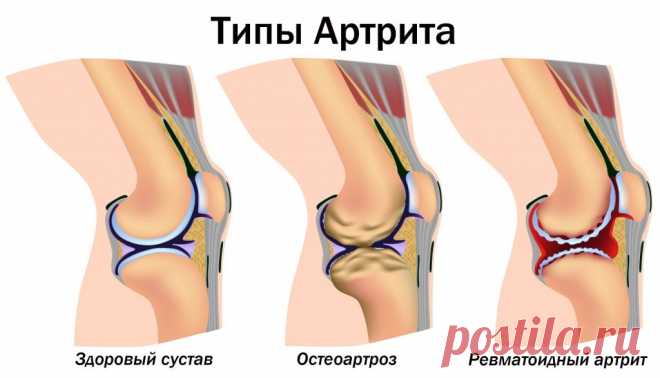 5 натуральных средств для лечения артрита и боли в суставах - Журнал для женщин Важная информация Артрит является наиболее распространенной причиной инвалидности во многих странах. По данным Центров по контролю и профилактике заболеваний, это заболевание затрагивает примерно 23% взрослых и 50% лиц в возрасте 65 лет и старше. Природные средства для лечения артрита: Куркума Куркума – ярко-желтая специя, используемая в индийских карри и других азиатских блюдах. Активным компонентом в […]