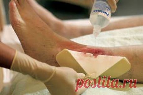 Трофические язвы и пролежни – рецепты народной медицины.