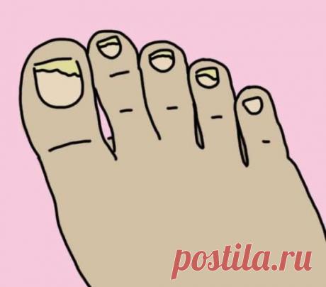 Она подержала ноги в ополаскивателе для рта 30 минут. То, что случилось потом, напоминает чудо!