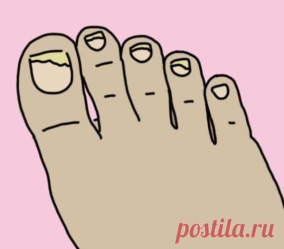 Она подержала ноги в ополаскивателе для рта 30 минут. То, что случилось потом, напоминает чудо!