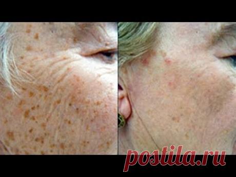 СПОСОБ, Который УДАЛИТ Все КОРИЧНЕВЫЕ ПЯТНА на КОЖЕ!