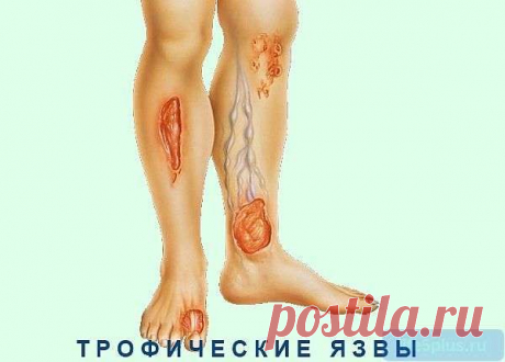 Трофическая язва: как и почему возникает, чем лечат |
