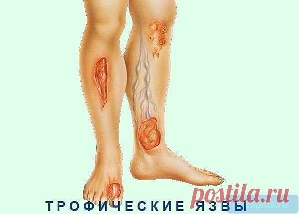 Трофическая язва: как и почему возникает, чем лечат |