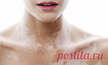 Причина появления белых пятен на коже именуемые – витилиго
Всем привет! Впервые я увидел белое пятно еще перед поступлением в высшее учебное заведение. Это был 2000-ый год. Начало нового века, новой истории человечества и, тут на тебе – новая и неприятная история моей жизни. С каждым последующим годом пятна разрастались. И я не мог найти причину всему происходящему. Я перечитал сотни книг, где хоть […]
Читай пост далее на сайте. Жми ⏫ссылку выше