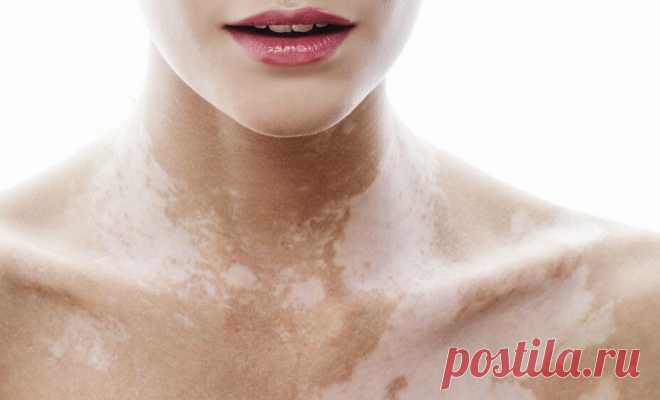 Причина появления белых пятен на коже именуемые – витилиго
Всем привет! Впервые я увидел белое пятно еще перед поступлением в высшее учебное заведение. Это был 2000-ый год. Начало нового века, новой истории человечества и, тут на тебе – новая и неприятная история моей жизни. С каждым последующим годом пятна разрастались. И я не мог найти причину всему происходящему. Я перечитал сотни книг, где хоть […]
Читай пост далее на сайте. Жми ⏫ссылку выше