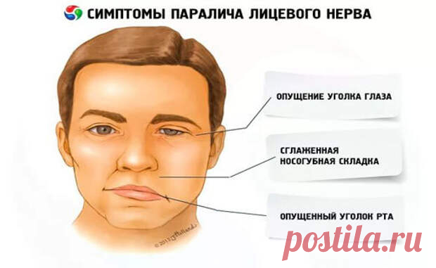 Лицо перекосило…
В 2003 году мне поставили диагноз невропатия лицевого нерва. Были асимметрия лица, слезотечение из глаза, глаз не закрывался. В больнице меня лечили хлоридом натрия, хлоридом калия, зуфиллином, дексаметазоном, анальгином, димедролом, лазиксом, нейромультивитом, диклофенаком, луцетамом, алоэ, прозерином, дибазолом, никотиновой кислотой, амитриптилином, МТ, УВЧ, ЛТ, токами...
Читай пост далее на сайте. Жми ⏫ссылку выше