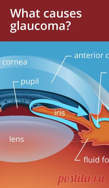 Three main causes of Glaucoma and who is at risk. [video]