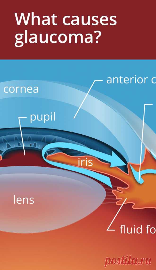 Three main causes of Glaucoma and who is at risk. [video]