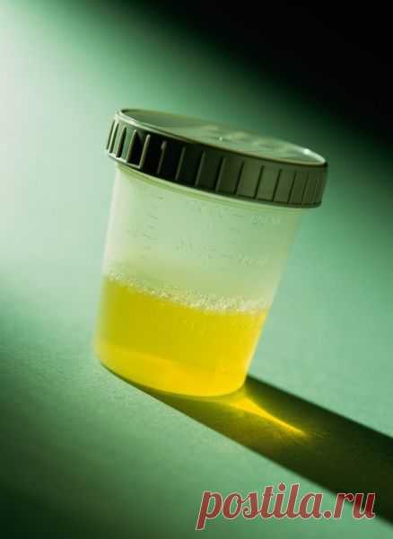 Как правильно сдавать анализ мочи.
Научиться правильно сдавать анализ мочи очень важно. Правильно сданный анализ мочи позволяет поставить верный диагноз и выбрать оптимальный способ лечения. Если при сборе анализа допущены нарушения, то результаты будут недостоверными. А значит диагностика болезни будет затруднена. В стационаре Вам расскажут, как сдать анализ мочи, соблюдая все нюансы правильного, а значит, эффективного сбора мочи. Но как правильно сдавать анализ мочи в домашних условиях?