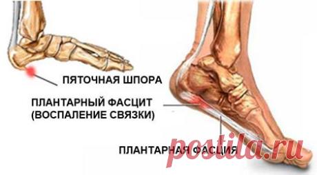 (3) Реальная история лечения пяточной шпоры.... - Наслаждаться здоровьем.