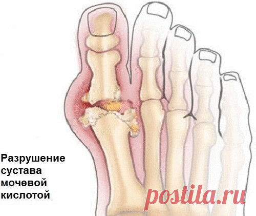 В чем опасность мочевой кислоты и как можно уменьшить ее количество?