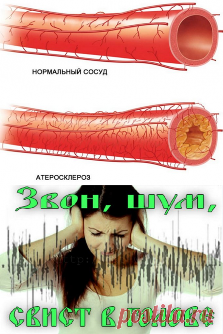 Шум в голове? Чистим сосуды и восстанавливаем мозговое кровообращение! - Что хочет женщина