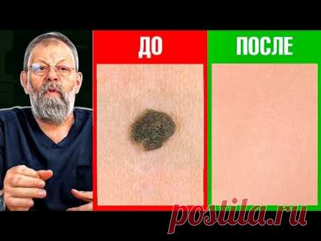 Кератомы. Причины. Главная точка помощи
