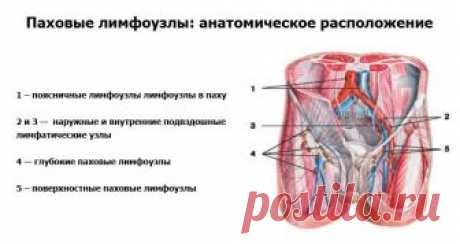 Удаление лимфоузла в паху