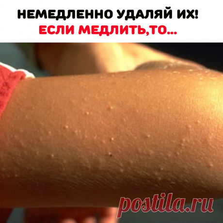 Если не убрать их, то прыщики
превратятся в большие волдыри-
водянки. К счастью, избавиться от них
просто: мажьте увлажняющим
средством с гликолевой кислотой.