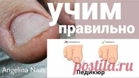 ВРАСТАЕТ НОГОТЬ / учим правильно подстригать / протезирование акрилом / педикюр подростку