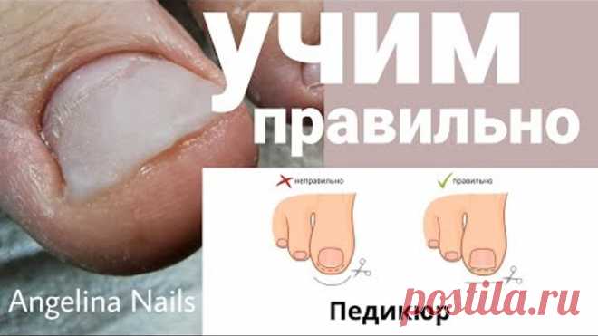 ВРАСТАЕТ НОГОТЬ / учим правильно подстригать / протезирование акрилом / педикюр подростку