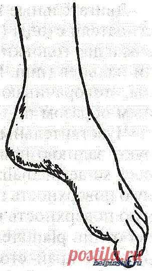 Контрактура сустава стопы