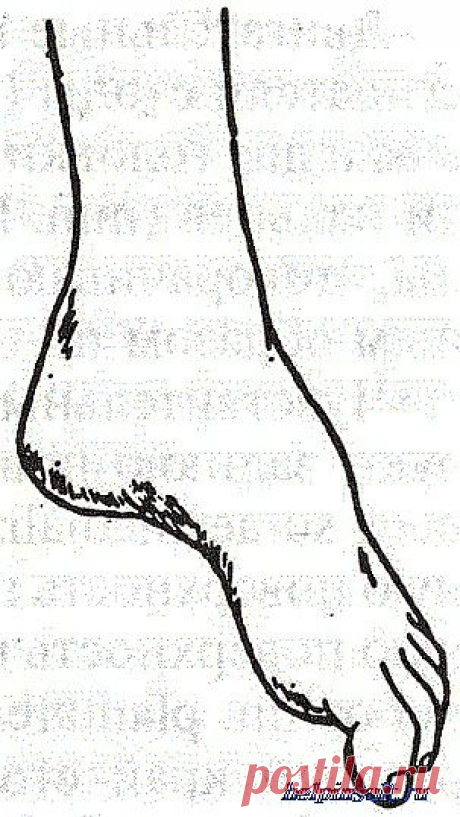 Контрактура сустава стопы